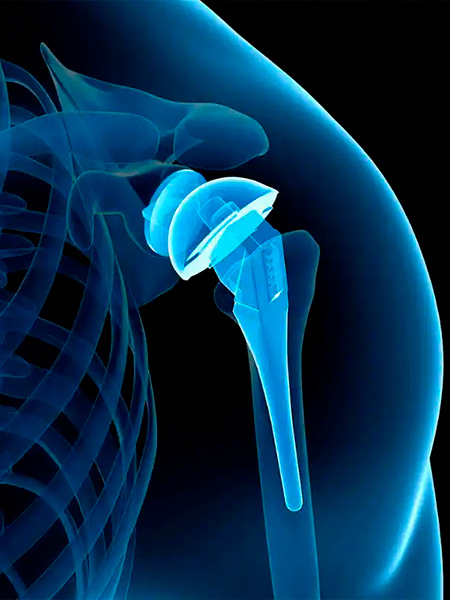 Artroplastia Artroplastia